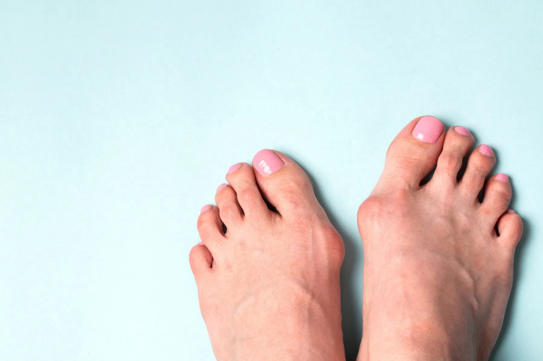 Zo ga je hallux valgus-klachten te lijf.jpg