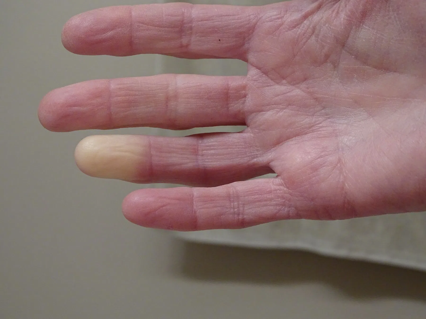 witte-vingers-door-van-raynaud-hardlopen-kou.jpg