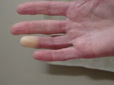 Thumbnail for article: Witte vingers bij kou? Misschien heb je het fenomeen van Raynaud
